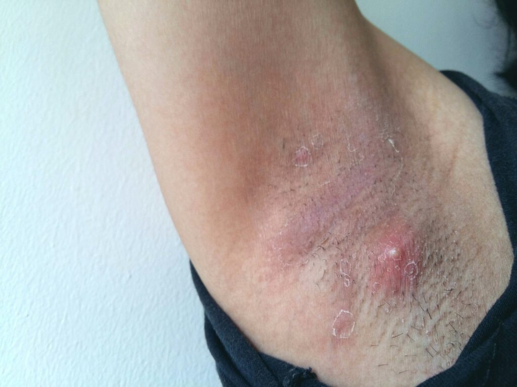 Furúnculo em axila.