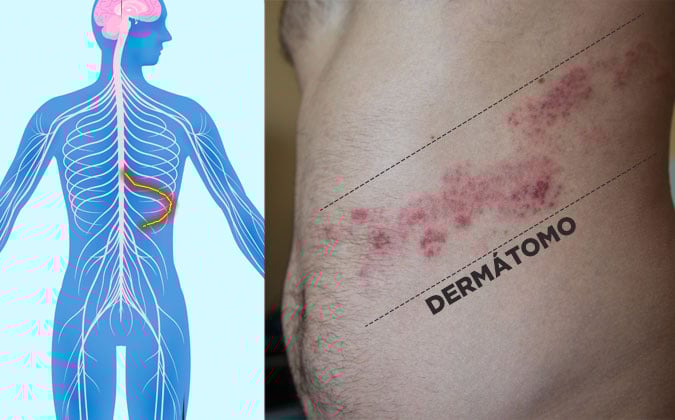 Quadro de herpes zoster em abdome.