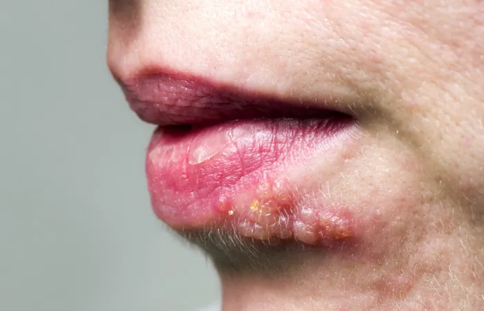 Lesão herpes em lábio